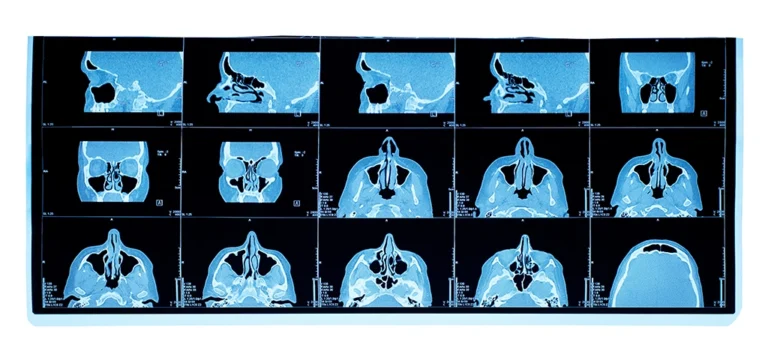Different Views Of The Maxillary Sinuses From A CT Scan