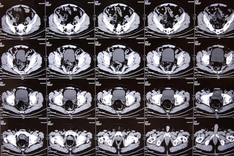 The Images Captured By A Pelvic CT Scan