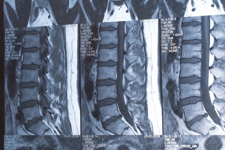 MRI Back Results Of The Lumbar Spine
